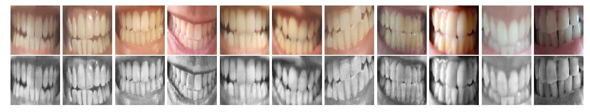 Imagens normalizadas da região de interesse (RoI) e seus aprimoramentos correspondentes no fluxo de trabalho automatizado do DeepTeeth.